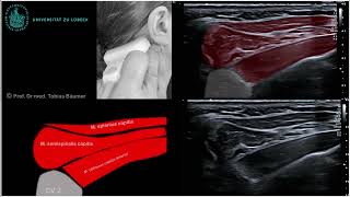 Sonographische Darstellung der kurzen Nackenmuskeln [upl. by Nylirak]