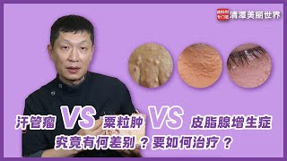 汗管瘤VS栗粒肿VS皮脂腺增生症究竟有何差别？要如何治疗 syringoma chinese subtitles [upl. by Alansen]