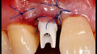 Immediate implantation amp Loading case using Dentium Digital GuideDrHoonJae Lee [upl. by Ardnuahs671]