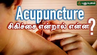 அக்குபஞ்சர் சிகிச்சை என்றால் என்ன Doctor On Call  06042019  PuthuyugamTV [upl. by Ahseia]