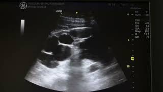 Ultrasound of spermatocele [upl. by Leamhsi]