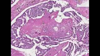 Histopathology BreastDuctal carcinoma in situ [upl. by Maureene]