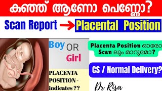 Gender Prediction Malayalam Anterior Placental Boy Girl കുഞ്ഞ് ആണോ പെണ്ണോ [upl. by Htaras90]