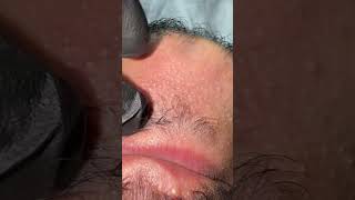 Blackheads amp Milia Whiteheads Removal blackheads skincare skincareroutine [upl. by Herriott]