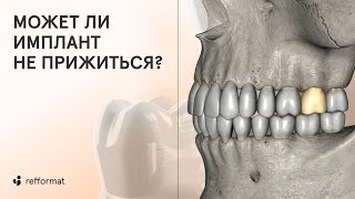 🔎 Тест на отторжение имплантов может ли имплант не прижиться И что дает гарантия на импланты [upl. by Odele]