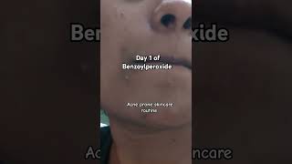 Benzoylperoxide skincareroutine acne benzoylperoxide combinationskin [upl. by Aldrich770]