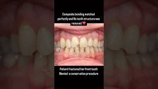 Chipped tooth Invisible composite bonding ￼ Betcha cant tell which tooth has been fixed [upl. by Yeliab]