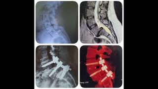 Lumbar Fusion for Lumbar Spinal Stenosis amp Listhesis  Dr Mahmoud Shoaib [upl. by Baun]