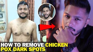 HOW To REMOVE CHICKEN POX DARK SPOTS From FACE  Zahid Akhtar [upl. by Andromeda]