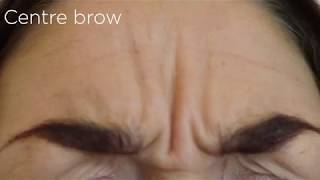 Botox removes Crows feet Centre Brow amp Forehead lines [upl. by Medrek787]