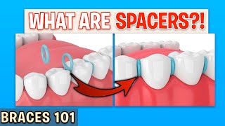 BRACES 101 Spacers For Braces  Treatment Minute Talk [upl. by Joycelin]