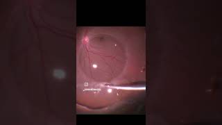 Vitrectomy for bullous retinal detachment with a superior break [upl. by Asiluy]