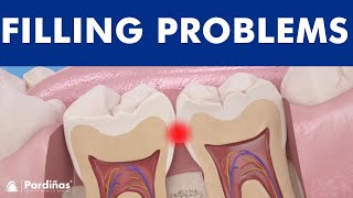 Problems with tooth filling  Overflowed filling and interproximal decay © [upl. by Nola]