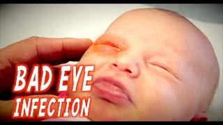 BAD EYE INFECTION Infant  Dr Paul [upl. by Ailesor]