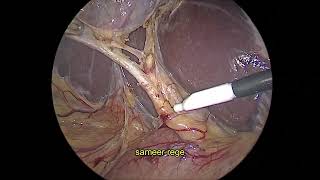 Laparoscopic Calots triangle dissection [upl. by Veejar]