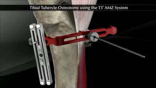 Ostéotomie de tubérosité tibiale antérieure TTA  Chirurgie instabilité de rotule  Dr Tournemine [upl. by Manda784]