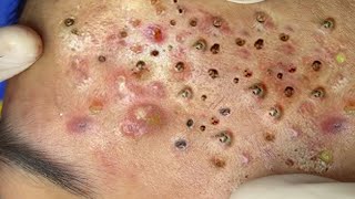 Big Cystic Acne Blackheads Extraction Blackheads amp Milia Whiteheads Removal Pimple Popping  2313 [upl. by Colfin935]