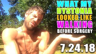 9 Days Prior to Surgery  What Walking wDystonia Looked Like [upl. by Akerdna605]