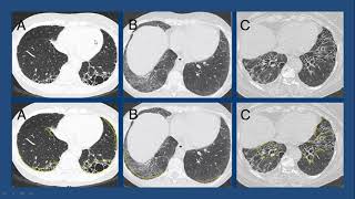 Fibrosis Pulmonar por tomografia computada [upl. by Areid777]