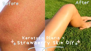 GET RID OF STRAWBERRY LEGS  KERATOSIS PILARIS  DARK SPOT REMOVAL My At Home Remedy Cure  DIY [upl. by Moreen]