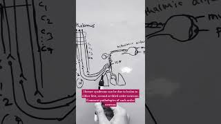 HORNER SYNDROME  lateral medullary syndrome lung apex tumor internal carotid dissection [upl. by Alton655]