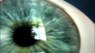 Laser Iridotomy for Angle Closure Glaucoma [upl. by Anauq]