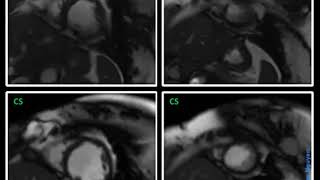 MRI Cardiac Arrythmia – Compressed Sensing CS  Siemens 15T Aera [upl. by Crifasi]