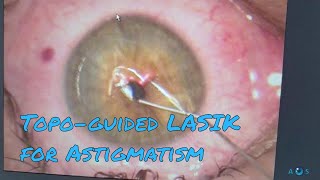 Contoura Vision Laser Eye Surgery for Astigmatism  Topographyguided LASIK PRK [upl. by Sakmar679]