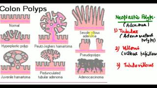 POLYPS  Colorectal polyps ADENOMA CARCINOMA SEQUENCE  PATHOLOGY  SURGERY [upl. by Drucie]