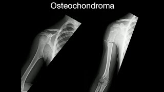 Osteochondroma [upl. by Argent211]