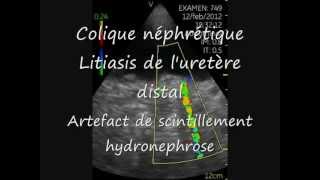 Vscan Calculs uretère distal Artefact scintillement Hydronephrose [upl. by Adnolehs]