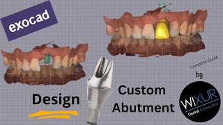 Design A Custom Abutment Maxillary Anterior [upl. by Washburn732]