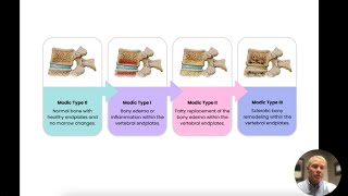 Demystifying Modic Changes  ChiroUp [upl. by Burn]