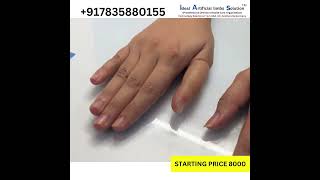 7835880155  Silicon Thumb Prosthesis [upl. by Aeniah]