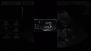 17 week ultrasound [upl. by Gladine333]