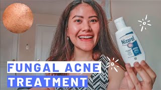 2 WEEKS MALASSEZIA FOLLICULITISFUNGAL ACNE TREATMENT  How to Get Rid of Fungal Acne Fansi Lantana [upl. by Einallem]