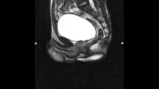 12 Shy Bladder  Paruresis Breath holding in an MRI [upl. by Philippe215]