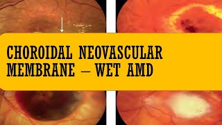 Choroidal neovascular membrane CNV  Wet AMD  TYPE 1 CNVM type 2 CNVM type 3 CNVM RAP [upl. by Htidra]