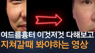 너무 솔직함 MTS준비물롤링방법리얼후기  여드름흉터 여드름자국 복원 프로젝트 [upl. by Ydaj577]