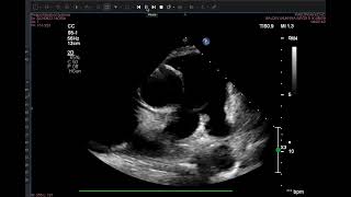 thrombus in LAA with DCM pectinate muscle [upl. by Ecnar]