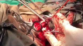 Heartworm Surgical Extraction  Caval Syndrome 62 heartworms extracted [upl. by Magna]