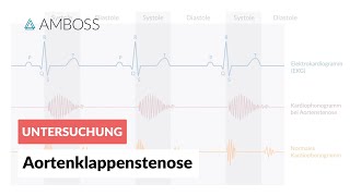 Aortenklappenstenose  Herzgeräusch  AMBOSS Video [upl. by Etnauj]