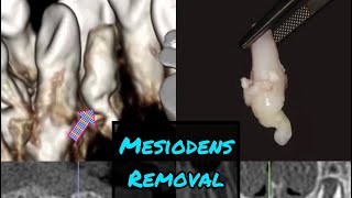 Black  White Version Mesiodens Removal from the Palate [upl. by Fulvia]