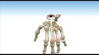 ReMotion™ Total Wrist Arthroplasty  Animated Surgical Technique [upl. by Culbertson]