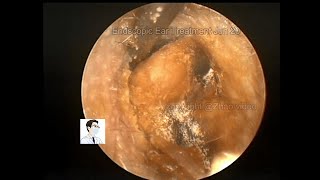 ear wax removing Severe cerumen embolism prosessing [upl. by Ardnoek]