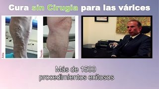 Cura para venas varices SIN CIRUGIA en Bogota Colombia  Tratamiento Ulceras varicosas Linfedema [upl. by Annette]