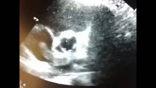 Transthoracice chocardiography Biatrial thrombus PFO [upl. by Eat]