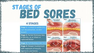 STAGES of BED SORES [upl. by Etat]