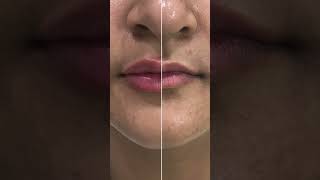 💋✨ Lip fillers skincare dermatologist skincareroutine [upl. by Delle]