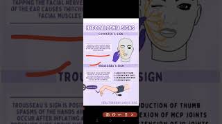 Hypocalcemia  Trousseaus sign amp Chvostek sign importantquestions nursingofficer nursing [upl. by Gader]